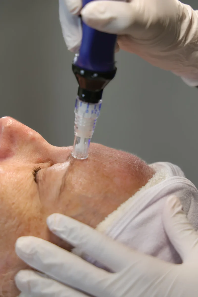 Regenerative microneedling at Skin Talk