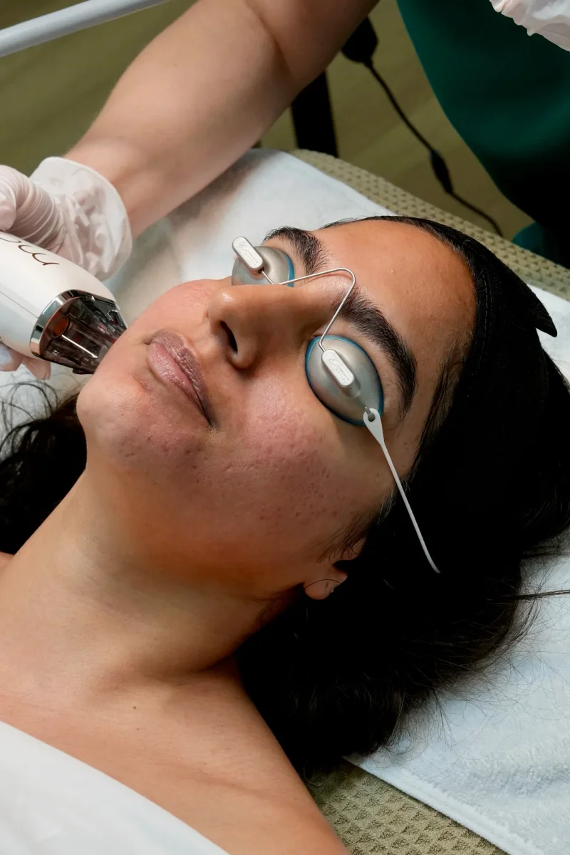 Moxi laser skin resurfacing at Skin Talk